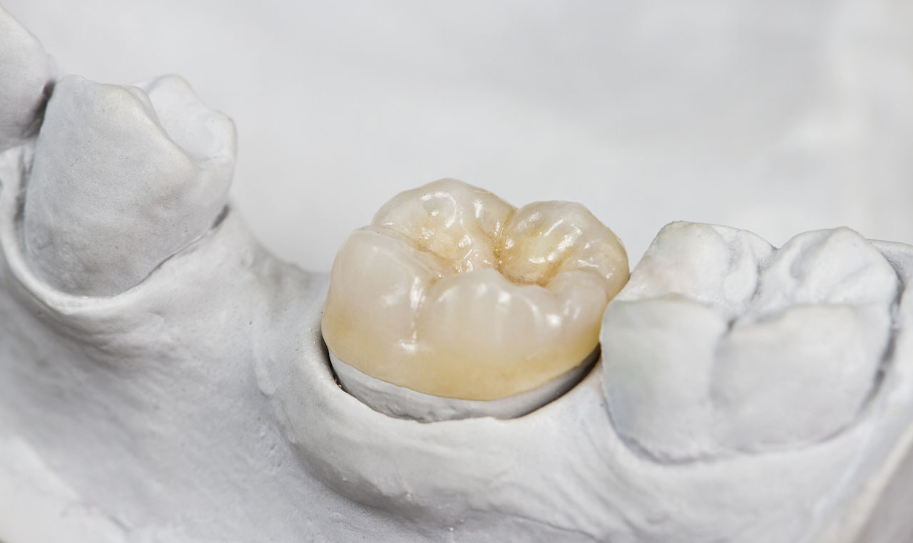 Cosa Succede Se Ingoi Un Dente