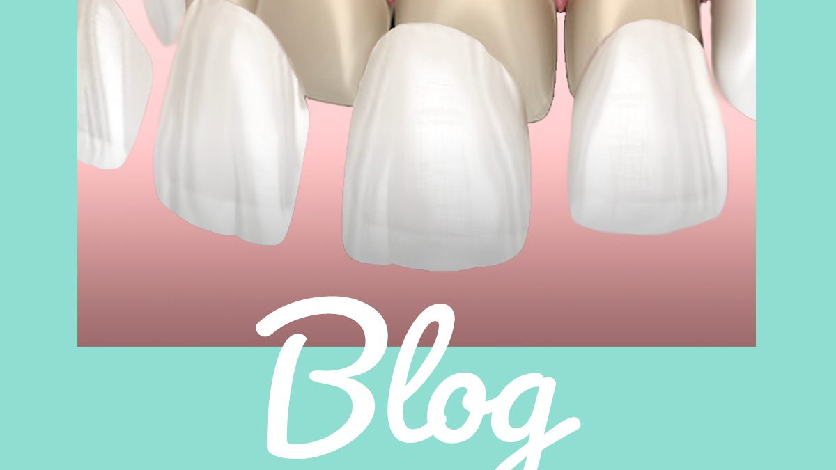 faccette, dentali, dentista, perchè, sceglierle